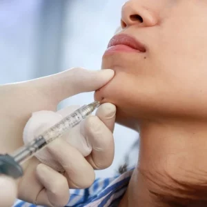 Chin Augmentation 1.1 ml