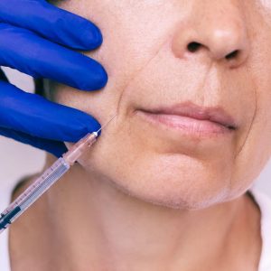 Smile Line Fillers 1.1 ml